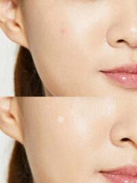 پچ ضد جوش کوزارکس ACNE PIMPLE