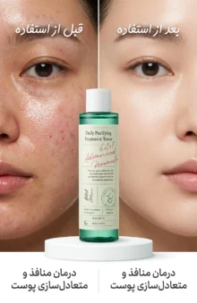 تونر ضد جوش اکسیس وای PURIFYING TREATMENT