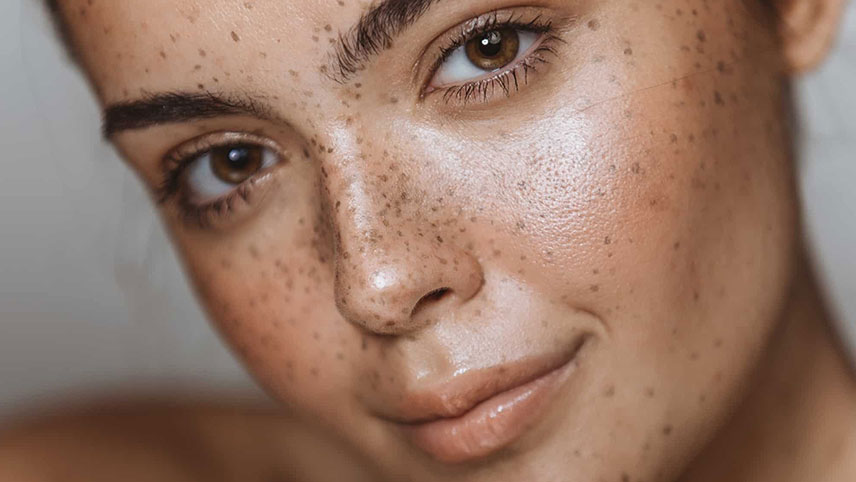 liver spots