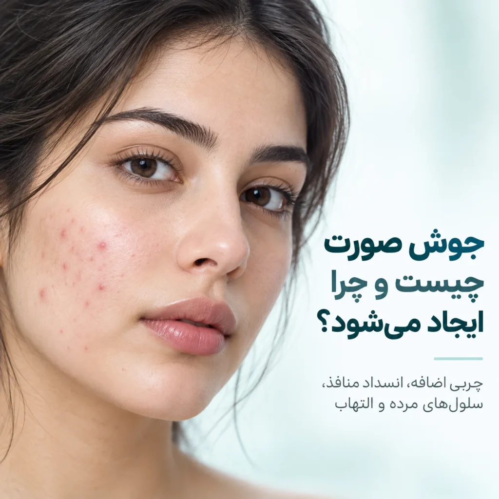 درمان جوش صورت؛ علت جوش، بهترین روش‌های درمان و محصولات ضدجوش